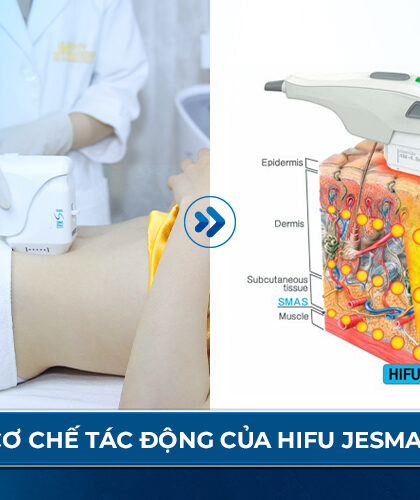 Cách chọn máy hifu phù hợp cho Spa