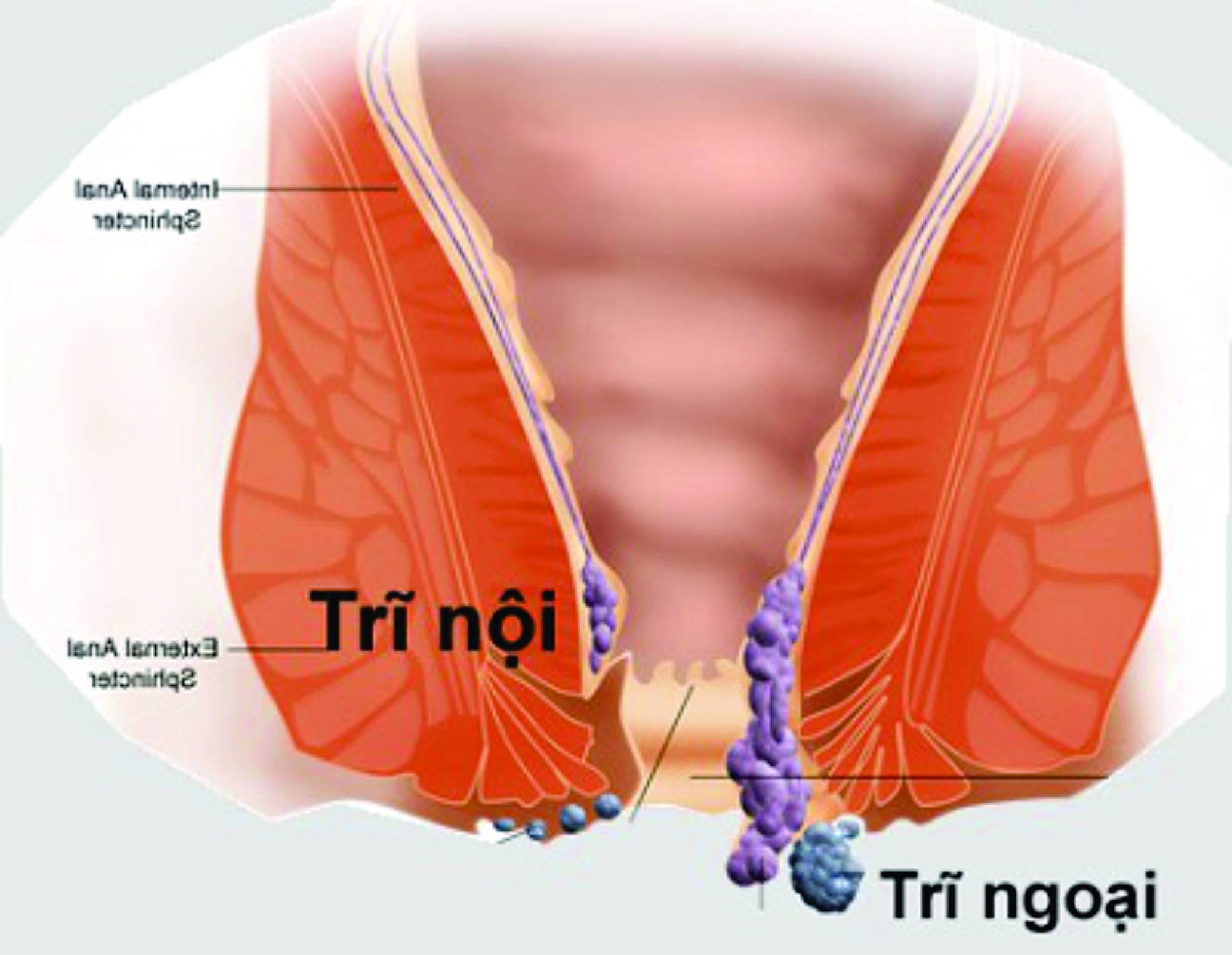 Bệnh trĩ ngoại là gì ? Nguyên nhân và tác hại của bệnh trĩ ngoại