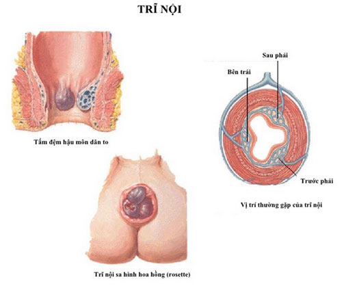 Triệu chứng của Bệnh trĩ nội
