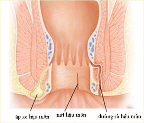 Triệu chứng bệnh Rò hậu môn