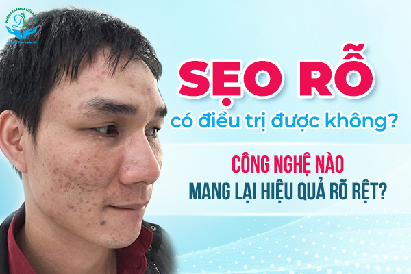 Trị Sẹo Rỗ Hiệu Quả #1 – Phác Đồ Chuẩn Da Liễu Từ A–Z